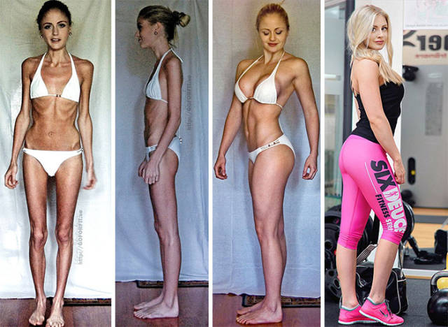 Anorexia Is Not The Final Verdict!
