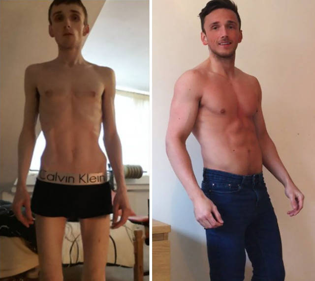 Anorexia Is Not The Final Verdict!
