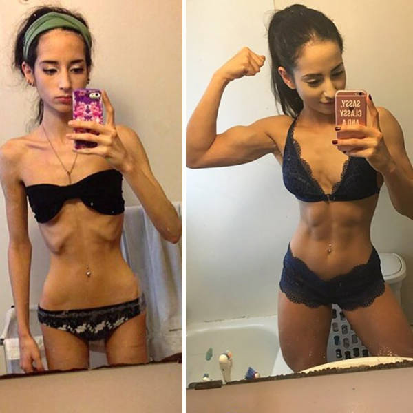 Anorexia Is Not The Final Verdict!