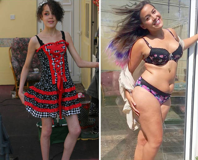 Anorexia Is Not The Final Verdict!