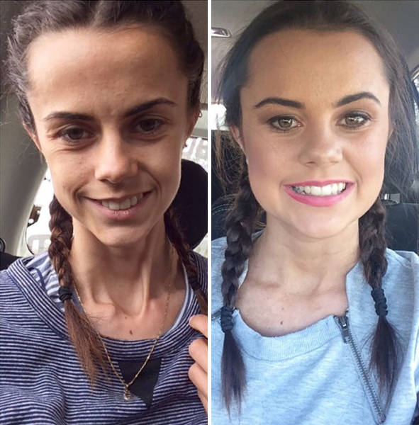 Anorexia Is Not The Final Verdict!