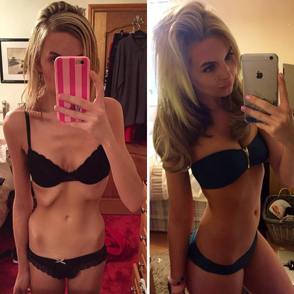 Anorexia Is Not The Final Verdict!