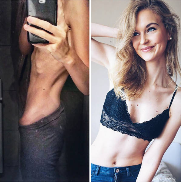 Anorexia Is Not The Final Verdict!