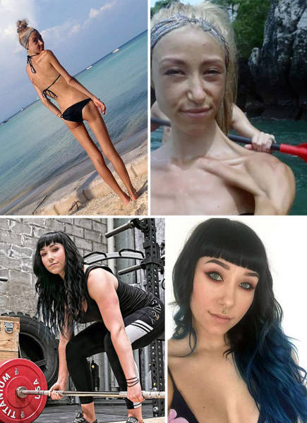 Anorexia Is Not The Final Verdict!