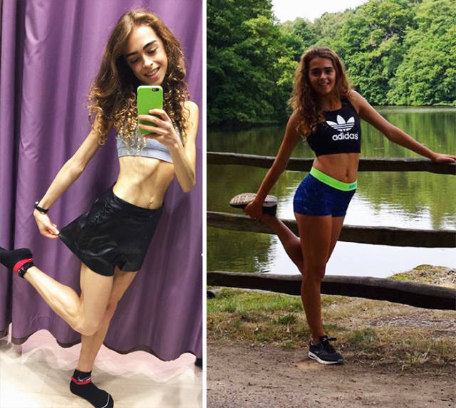 Anorexia Is Not The Final Verdict!