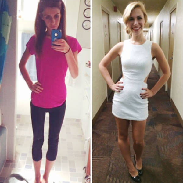 Anorexia Is Not The Final Verdict!