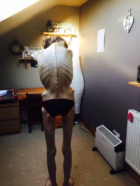 From Anorexia To An Amazing Body!