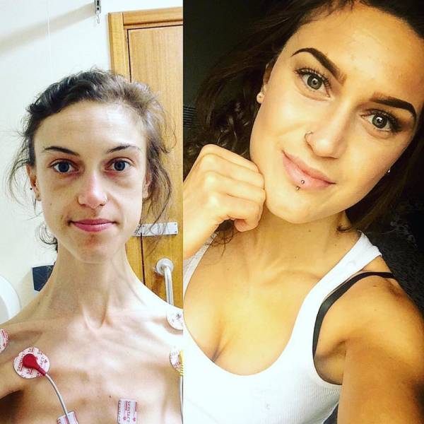 From Anorexia To An Amazing Body!