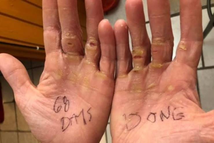 How Your Hands Will Look After Crossing Atlantic Ocean