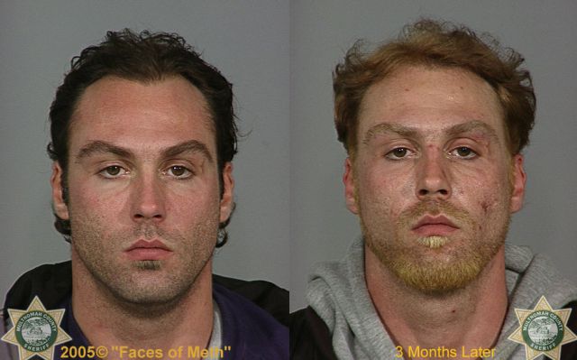 Meth Addicts: Before and After