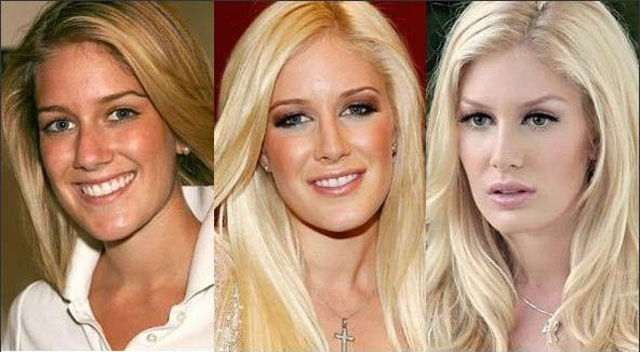 Celebrity Plastic Surgery Before & After