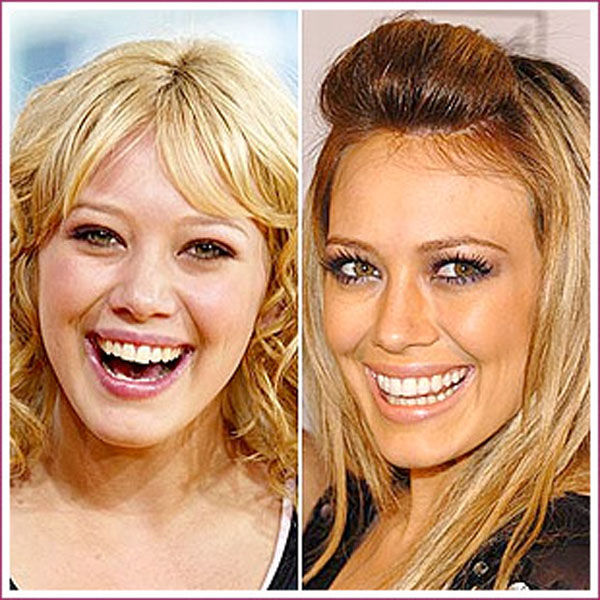 Celebrity Plastic Surgery Before & After
