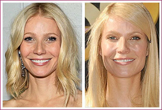 Celebrity Plastic Surgery Before & After