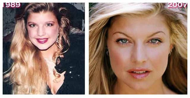 Celebrity Plastic Surgery Before & After