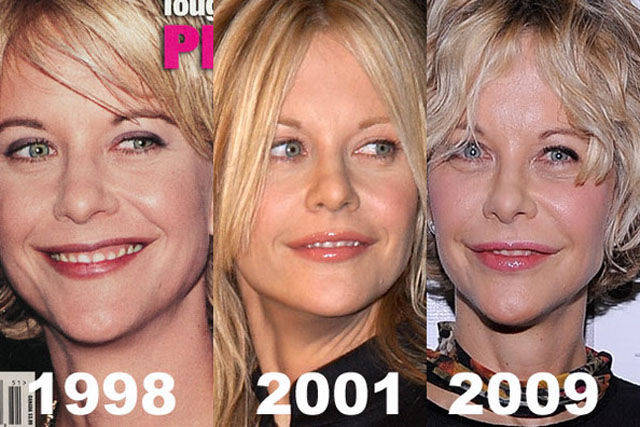 Celebrity Plastic Surgery Before & After