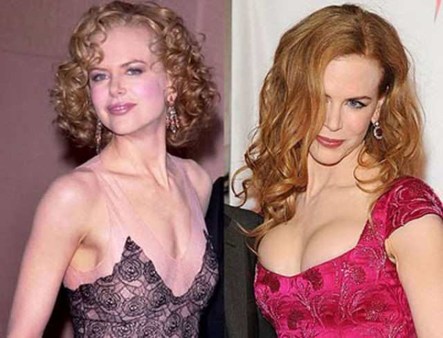 Celebrity Plastic Surgery Before & After