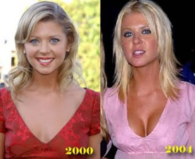 Celebrity Plastic Surgery Before & After
