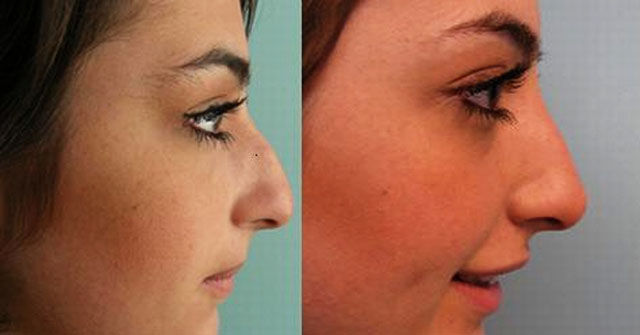 Celebrity Plastic Surgery Before & After