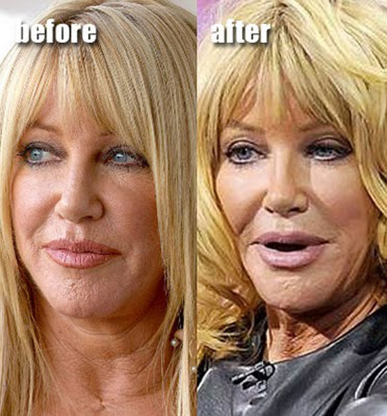 Celebrity Plastic Surgery Before & After