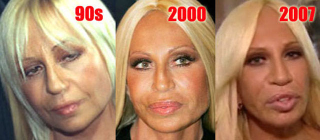 Celebrity Plastic Surgery Before & After