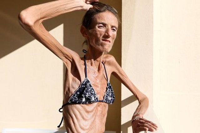 Her Dream Body Is Killing Her