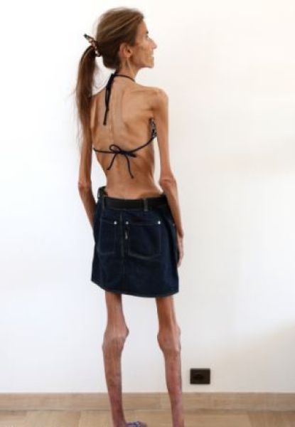 Her Dream Body Is Killing Her