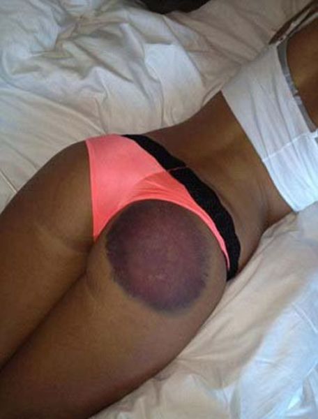 Playboy Model’s Butt Involved in Hit-and-Miss Accident