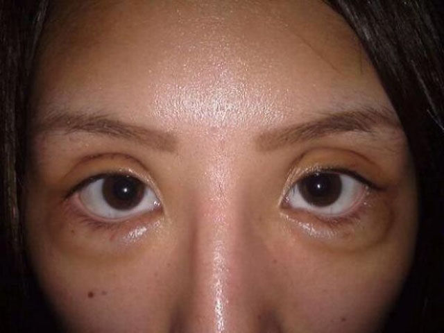 Japanese Porn Star Pre and Post Plastic Surgery