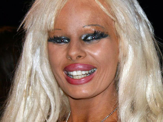 Plastic Surgery Fails That Are Just Wrong