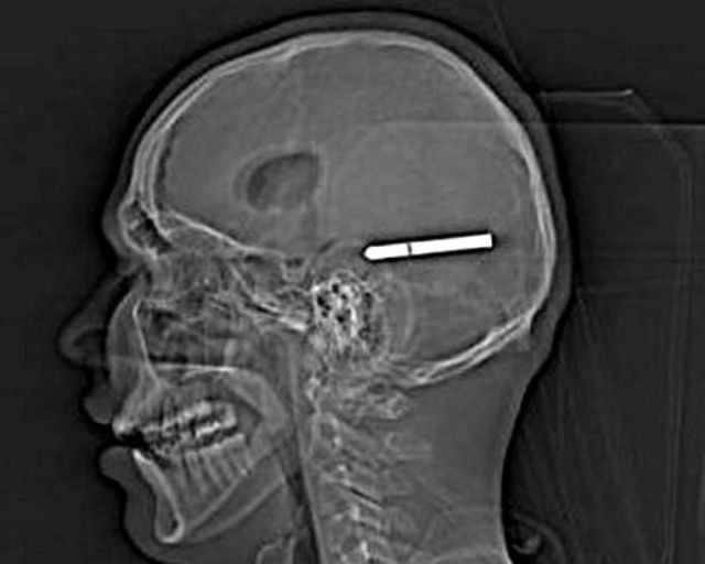 The Most Bizarre Items That Have Gotten Stuck in People’s Bodies