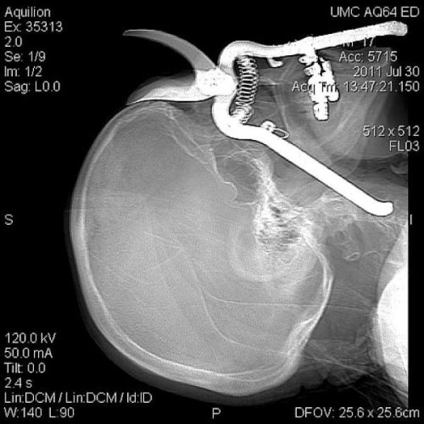 The Most Bizarre Items That Have Gotten Stuck in People’s Bodies