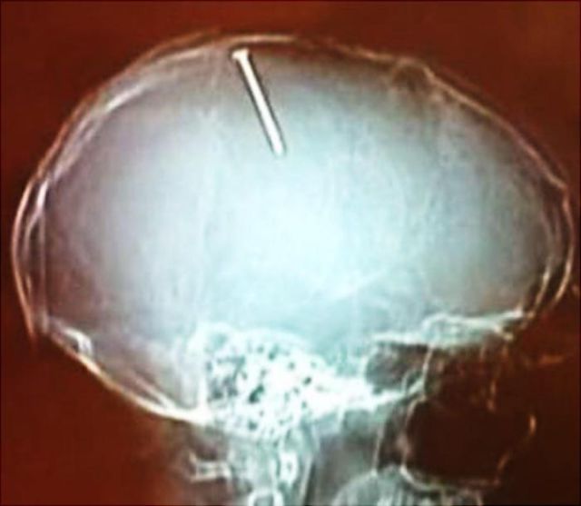 The Most Bizarre Items That Have Gotten Stuck in People’s Bodies