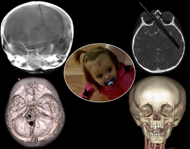 The Most Bizarre Items That Have Gotten Stuck in People’s Bodies