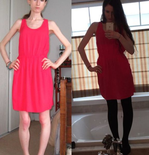 A Drastic Eating Disorder Recovery That Is Truly Amazing